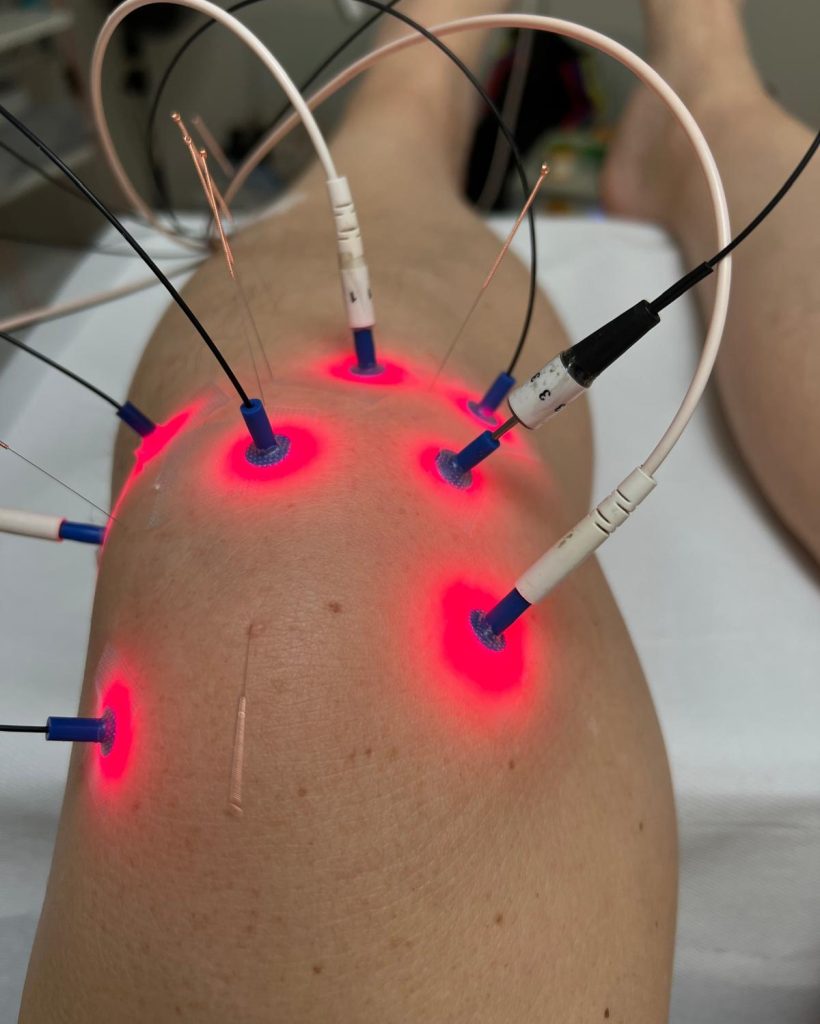 Hier ziet u acupunctuur in combinatie met soft laser therapie.